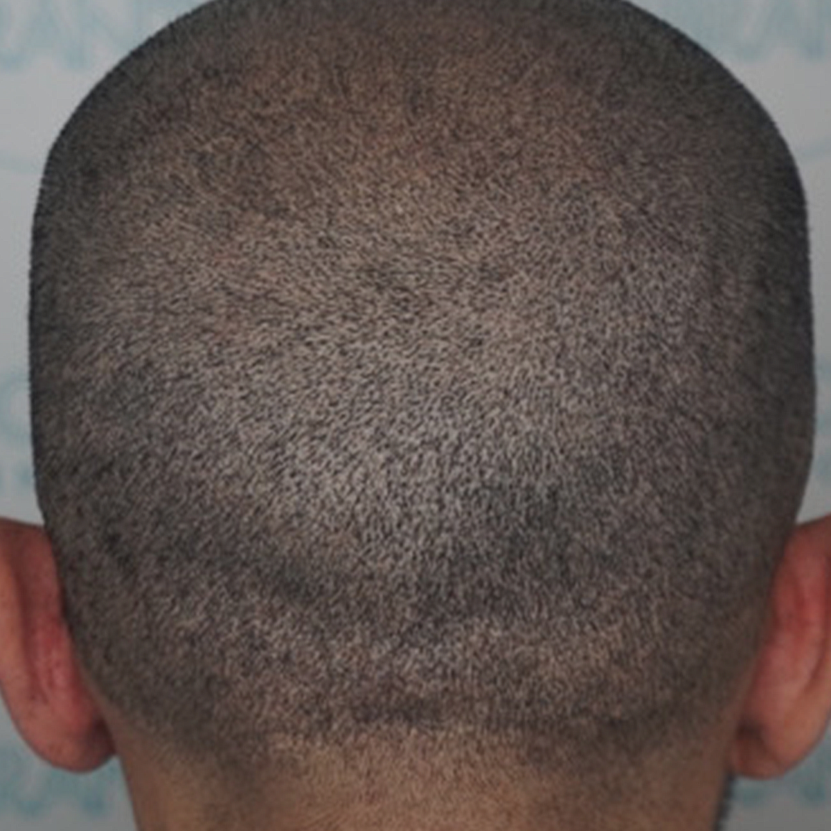 FUE Scars - After Treatment