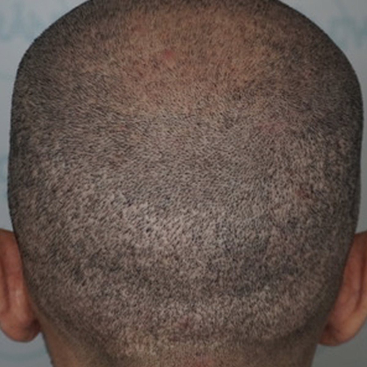 FUE Scars - Before Treatment
